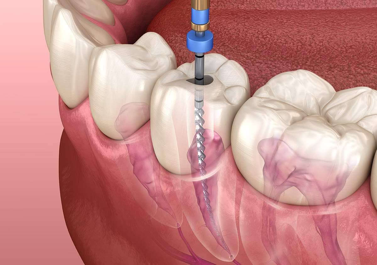Endodontic Treatment