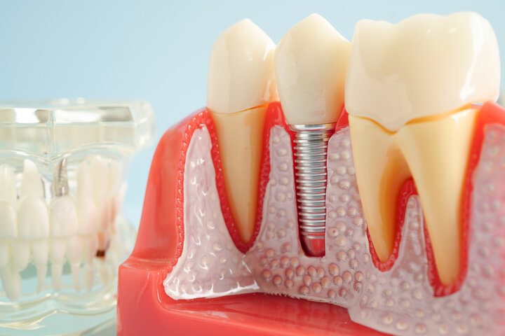 Dental Implants